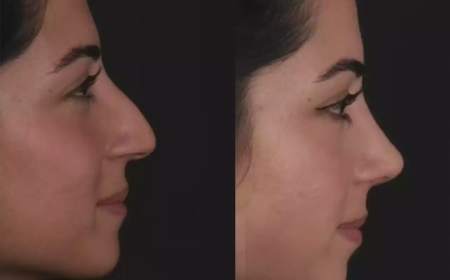 How to Choose the Best Rhinoplasty Surgeons in Dubai