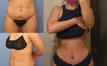 Tummy Tuck in Dubai: Experienced Surgeons Delivering Beautiful Results