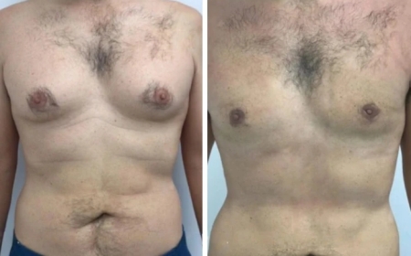 Gynecomastia in Dubai: The Difference Between Fat and Glandular Tissue Removal