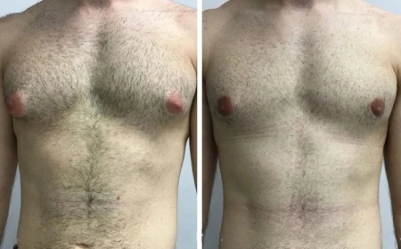 Advanced Laser Treatments for Gynecomastia in Dubai