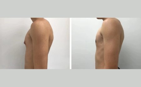 Top Benefits of Choosing Gynecomastia Surgery in Dubai