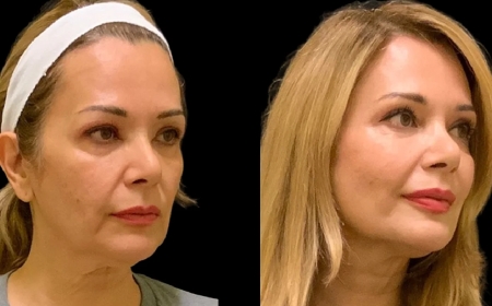 The Advantages of Getting Cheek Fillers at the Best Plastic Surgeons in Dubai