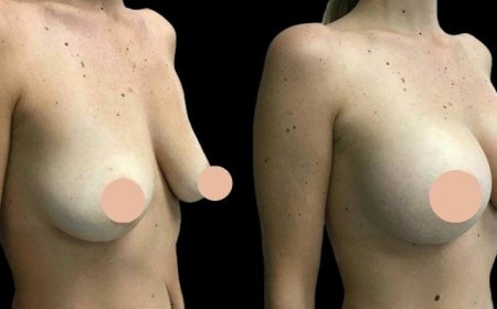 Impact of Breast Augmentation Surgery in Dubai on Self-Confidence