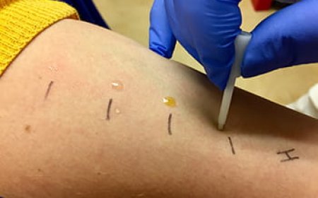 Top 5 Reasons to Get Allergy Testing in Dallas This Year