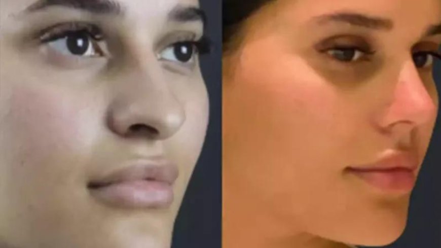 Best Septoplasty Surgeons in Dubai: Restore Your Breathing Comfort