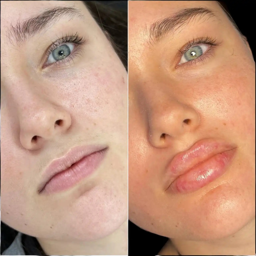 Find Confidence with the Best Doctors in Dubai for Fillers