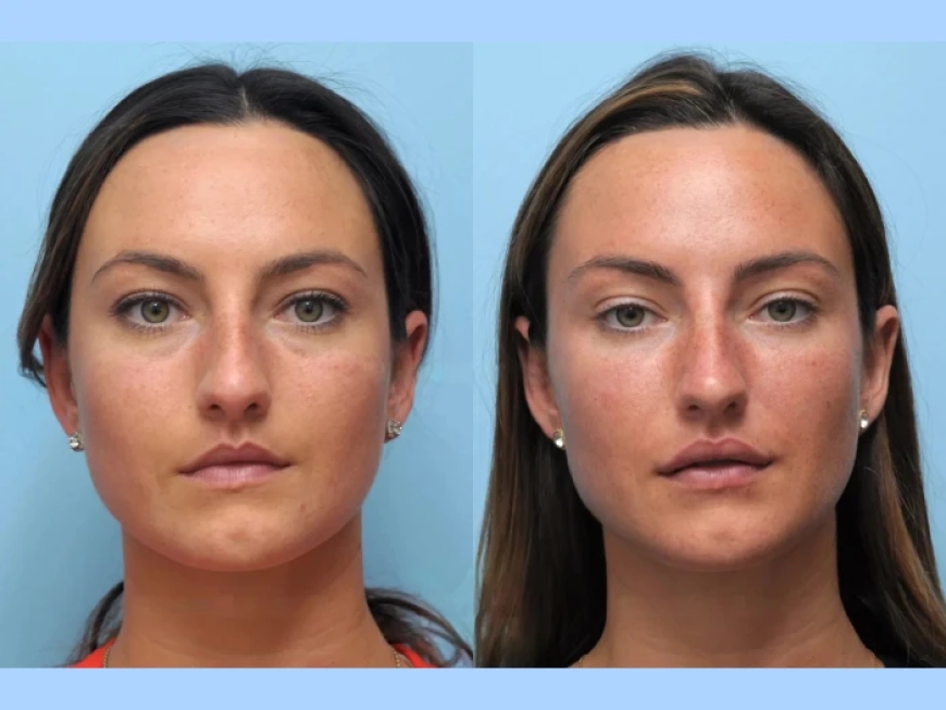 Thread Lift Experts: Best Doctors in Dubai for Non-Surgical Enhancements