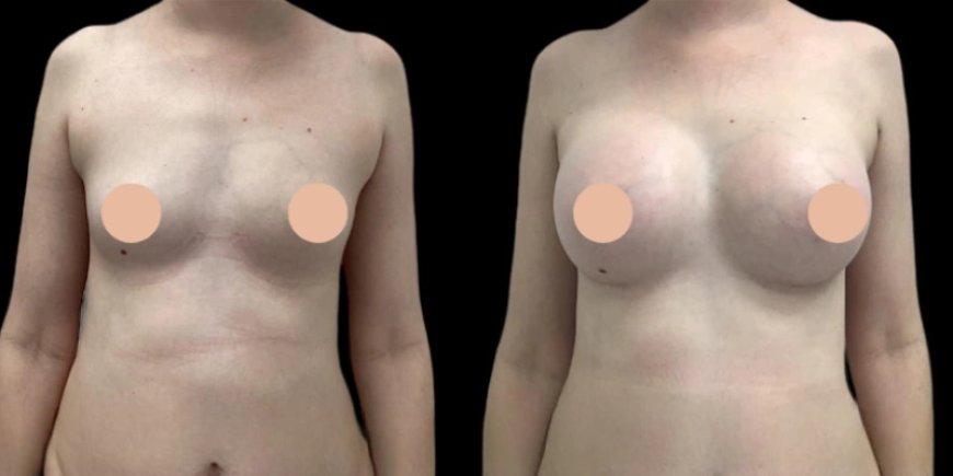 Dubai’s Hidden Gems: Best Breast Augmentation Surgeons You Haven’t Heard Of