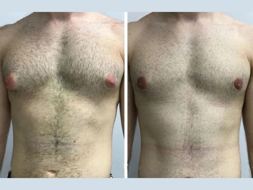 Advanced Laser Treatments for Gynecomastia in Dubai