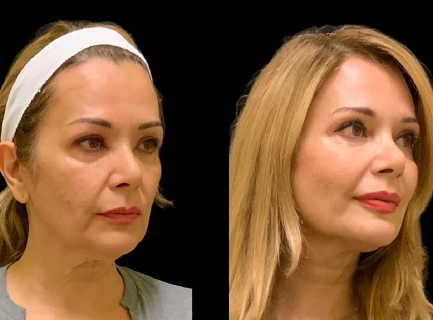 The Advantages of Getting Cheek Fillers at the Best Plastic Surgeons in Dubai