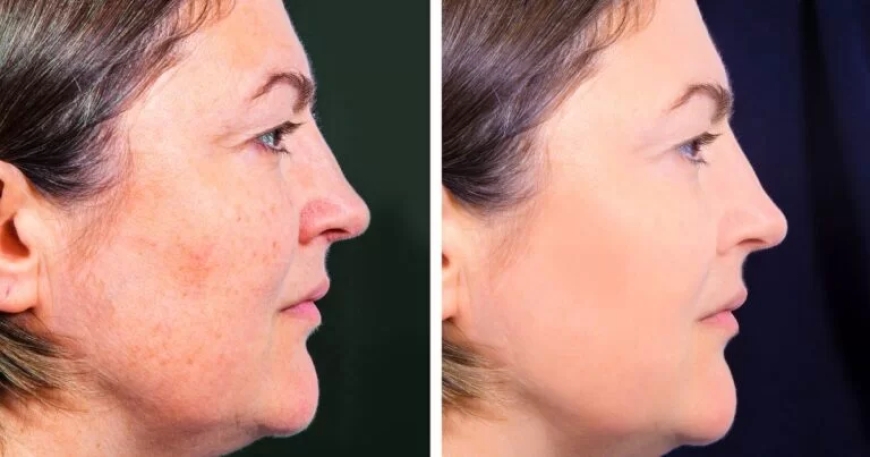 Top Questions About Profhilo Answered by the Best Plastic Surgeon in Dubai