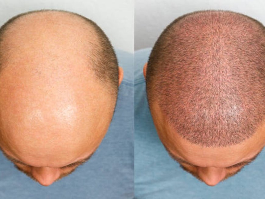 Say Goodbye to Baldness: Opt for Hair Transplant in Bhubaneswar
