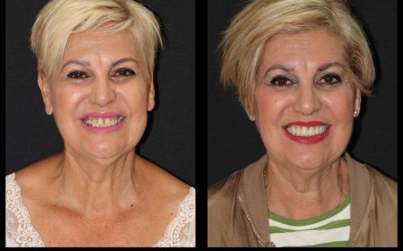 Blanqueamiento Dental en Hospitalet de Llobregat Dientes Más Blancos y Brillantes
