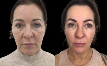 Why Choose the Best Plastic Surgeon in Dubai for Your Profhilo Procedure