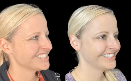 Can Botox Boost Confidence? The Best Plastic Surgeon in dubai Weighs In