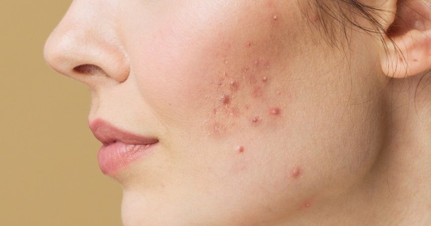 Transform Your Skin: Trusted Solutions for Acne Scars, Eczema & Alopecia Treatment